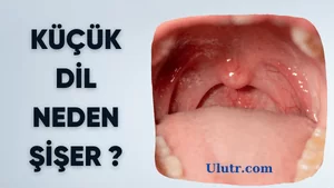 küçük dil şişmesi